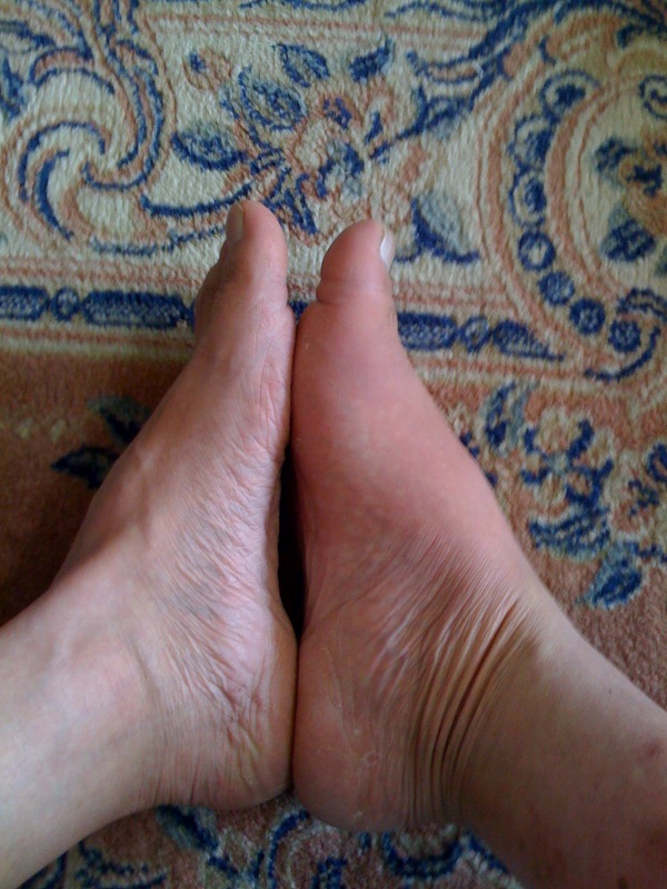 腫れ上がった足.jpg